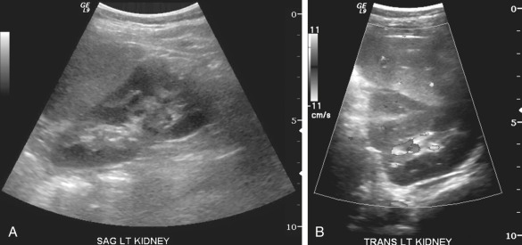 Figure 69-4, A, Sagittal ultrasound image shows classic bulge arising from the lateral cortex of the left kidney consistent with a dromedary hump. B, Transverse ultrasound image of the left kidney shows a dromedary hump and its relation to the adjacent spleen.