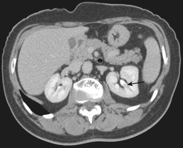 Figure 69-5, Delayed-phase contrast-enhanced computed tomography scan shows aberrant papilla with small oval defect with broad base (arrow) arising from the base of an upper pole minor calyx in the left kidney.