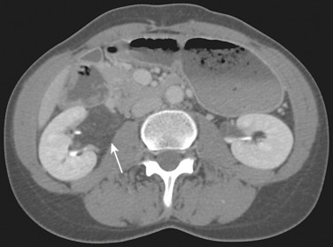 Figure 69-6, Axial computed tomography delayed-phase image shows fat density near the right renal hilum (arrow) consistent with sinus lipomatosis.