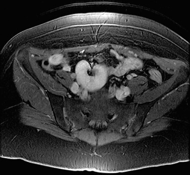 Figure 69-7, T1-weighted, fat-saturated, contrast-enhanced axial magnetic resonance image of the pelvis confirms a pelvic right kidney.