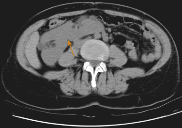 Figure 69-8, Axial computed tomography image shows fused kidney to the right of midline (arrow) consistent with crossed-fused ectopia.