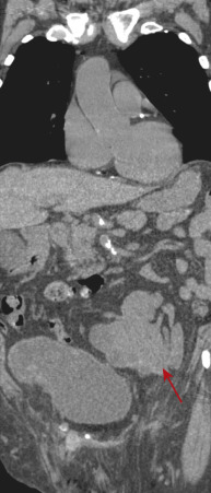 Figure 69-9, Coronal reformatted computed tomography image shows disc-shaped fused kidneys (arrow) consistent with a pancake kidney.