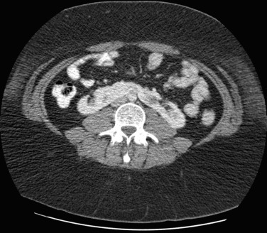 Figure 69-10, Axial contrast-enhanced computed tomography scan shows classic horseshoe kidney with fusion of both lower poles across midline.