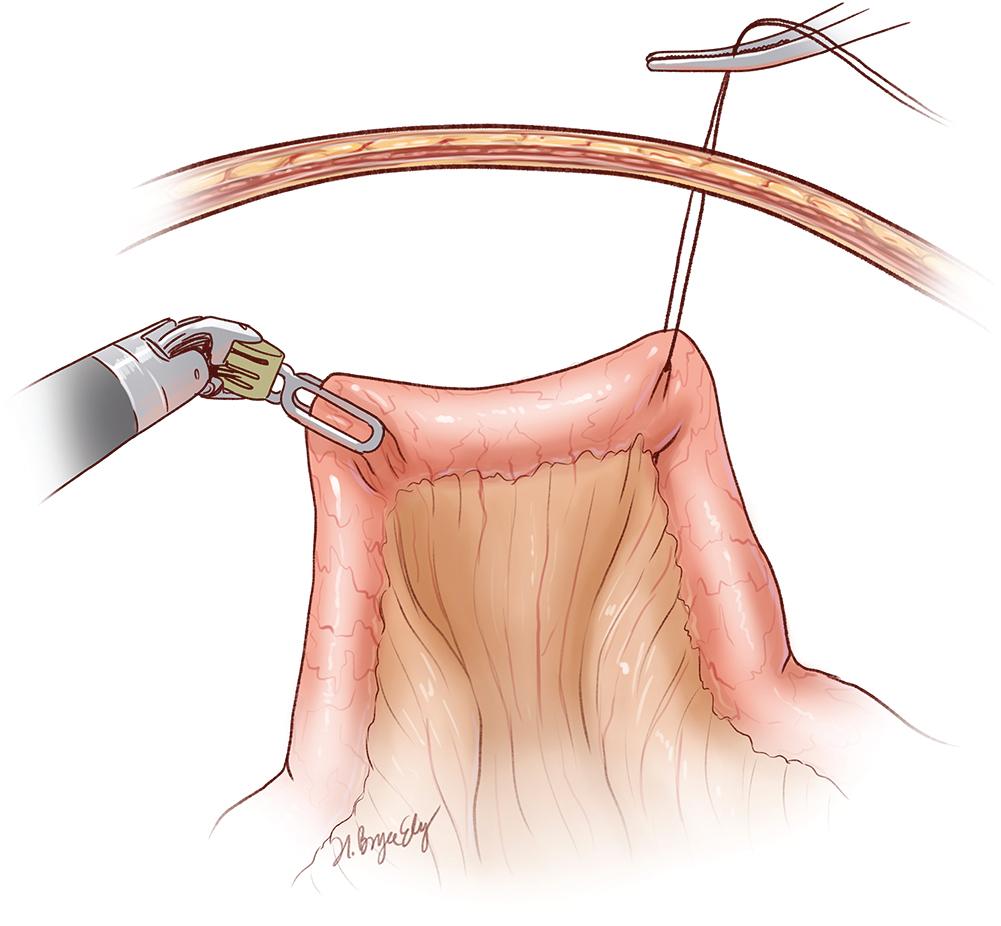 Fig. 26.2, Marionette Stitch.