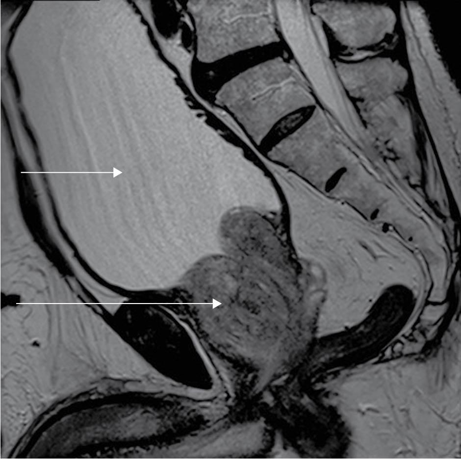 Figure 59, MRI (sagittal section) of a patient who presented with acute urinary retention .