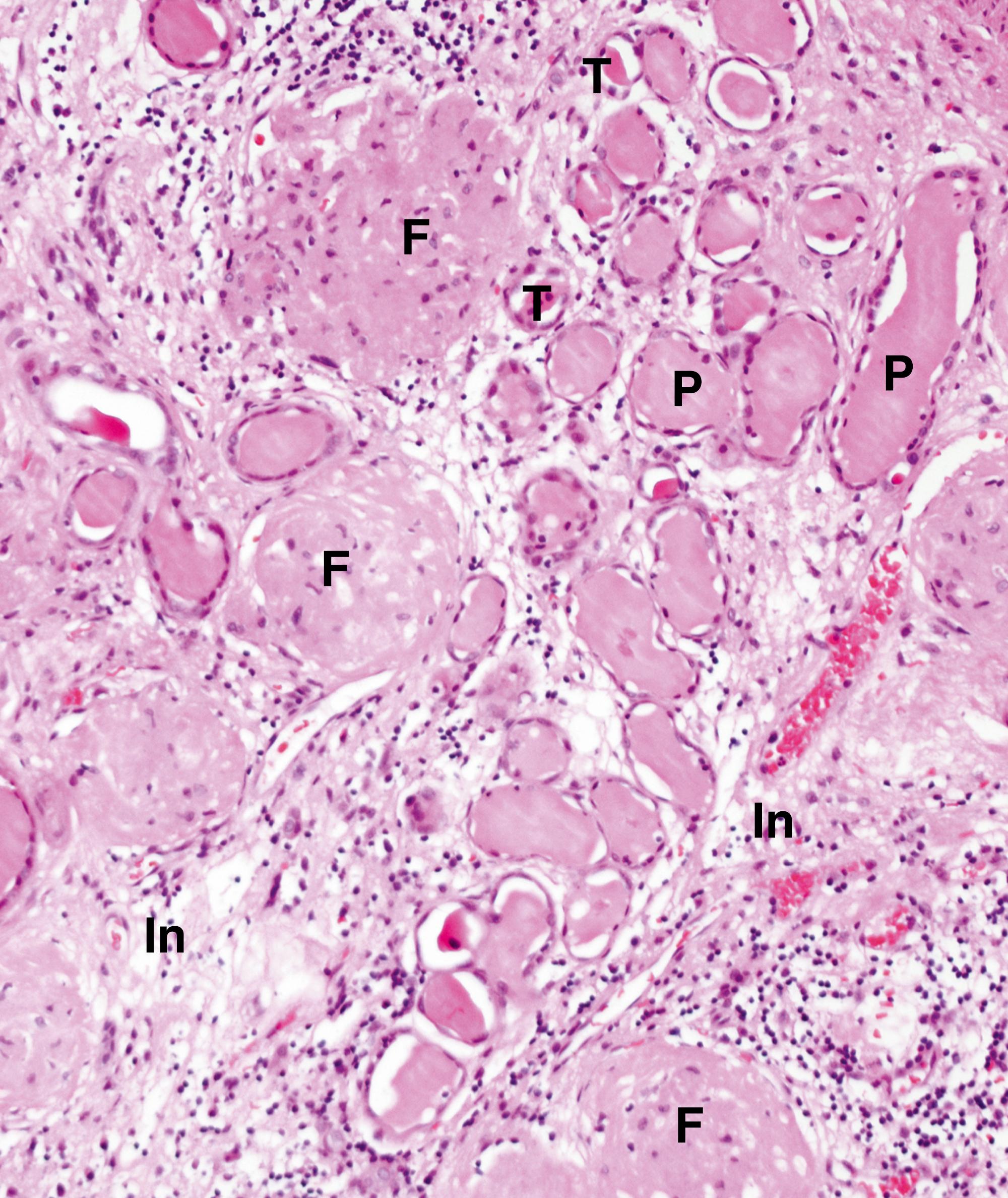 Fig. 15.1, End-stage kidney (MP).