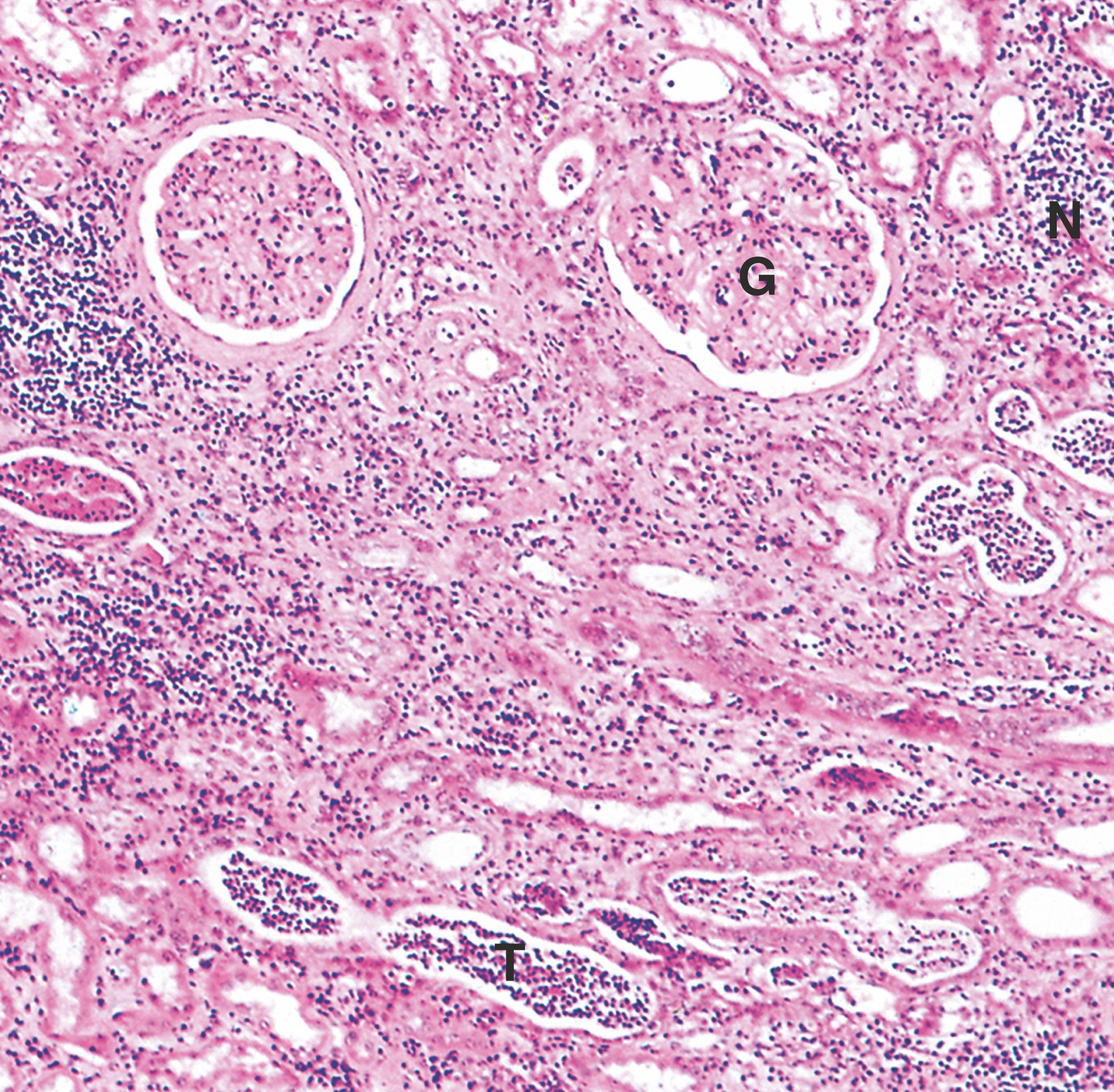 Fig. 15.11, Acute pyelonephritis (MP).