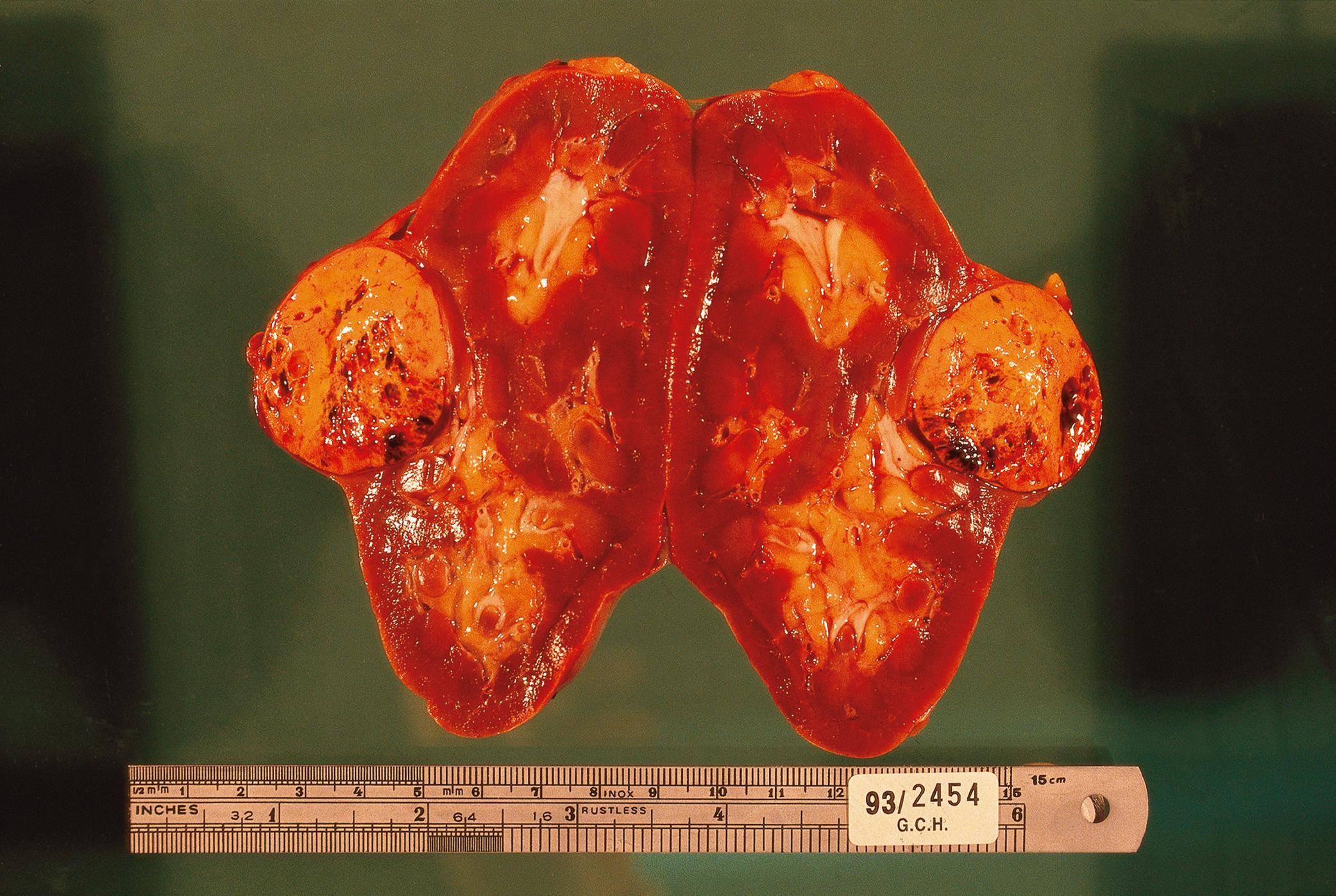 E-Fig. 15.9 G, Renal cell carcinoma. There is a well circumscribed, spherical tumour 30 mm in diameter bulging through the cortical surface of the kidney. Its cut surface is bright yellow. It shows solid areas, cystic areas and areas of haemorrhage.