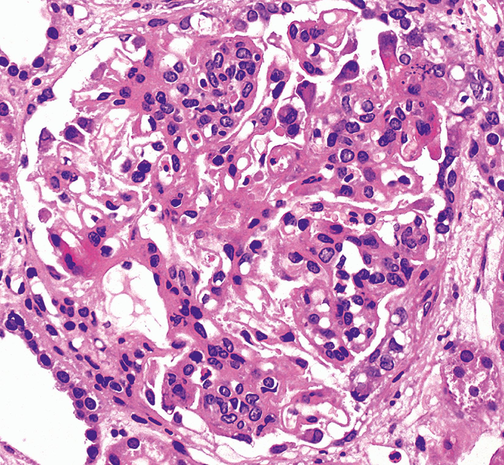 Fig. 16.9, Glomerulonephritis