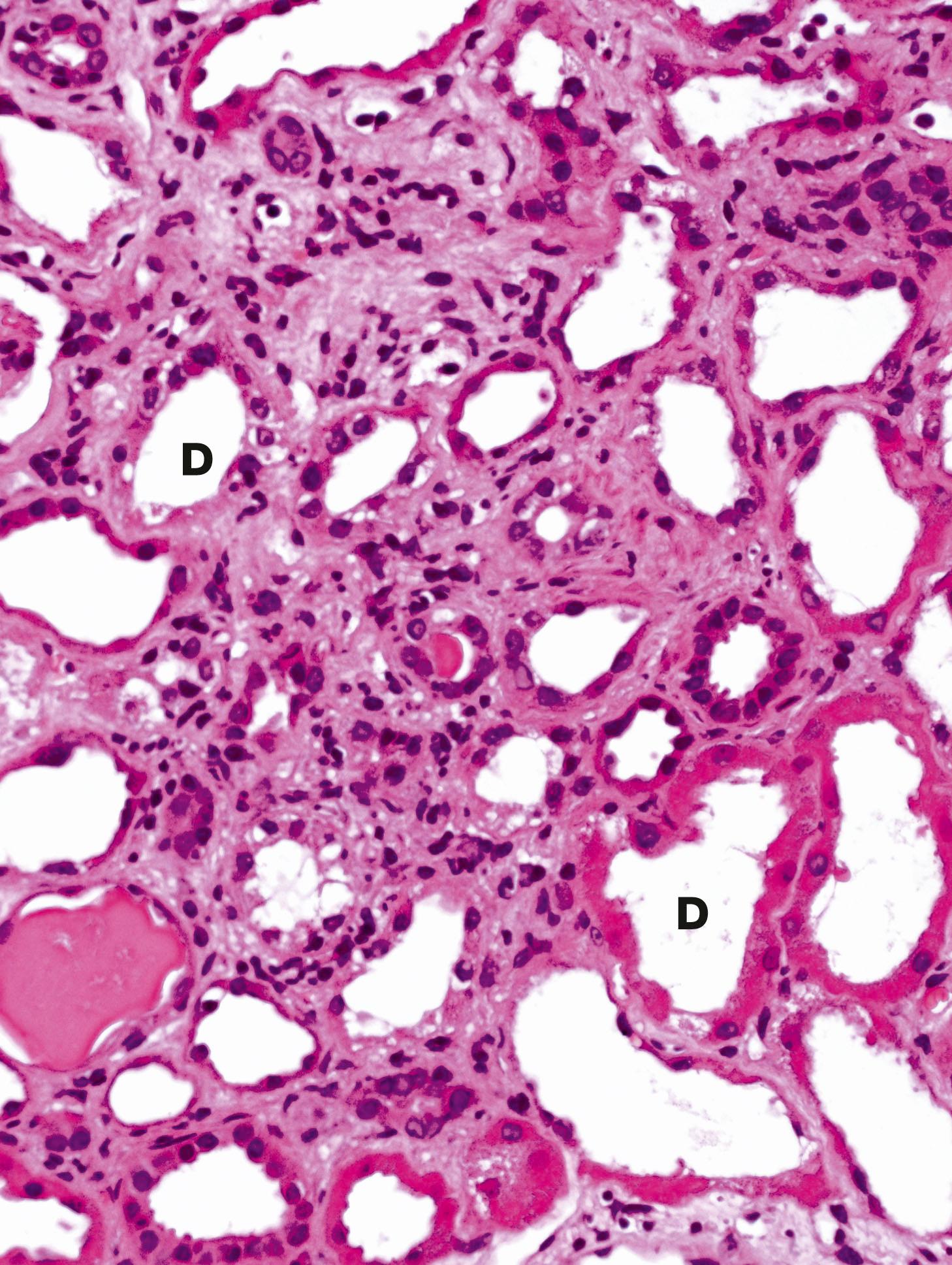 E-Fig. 16.4, Acute tubular necrosis (MP)