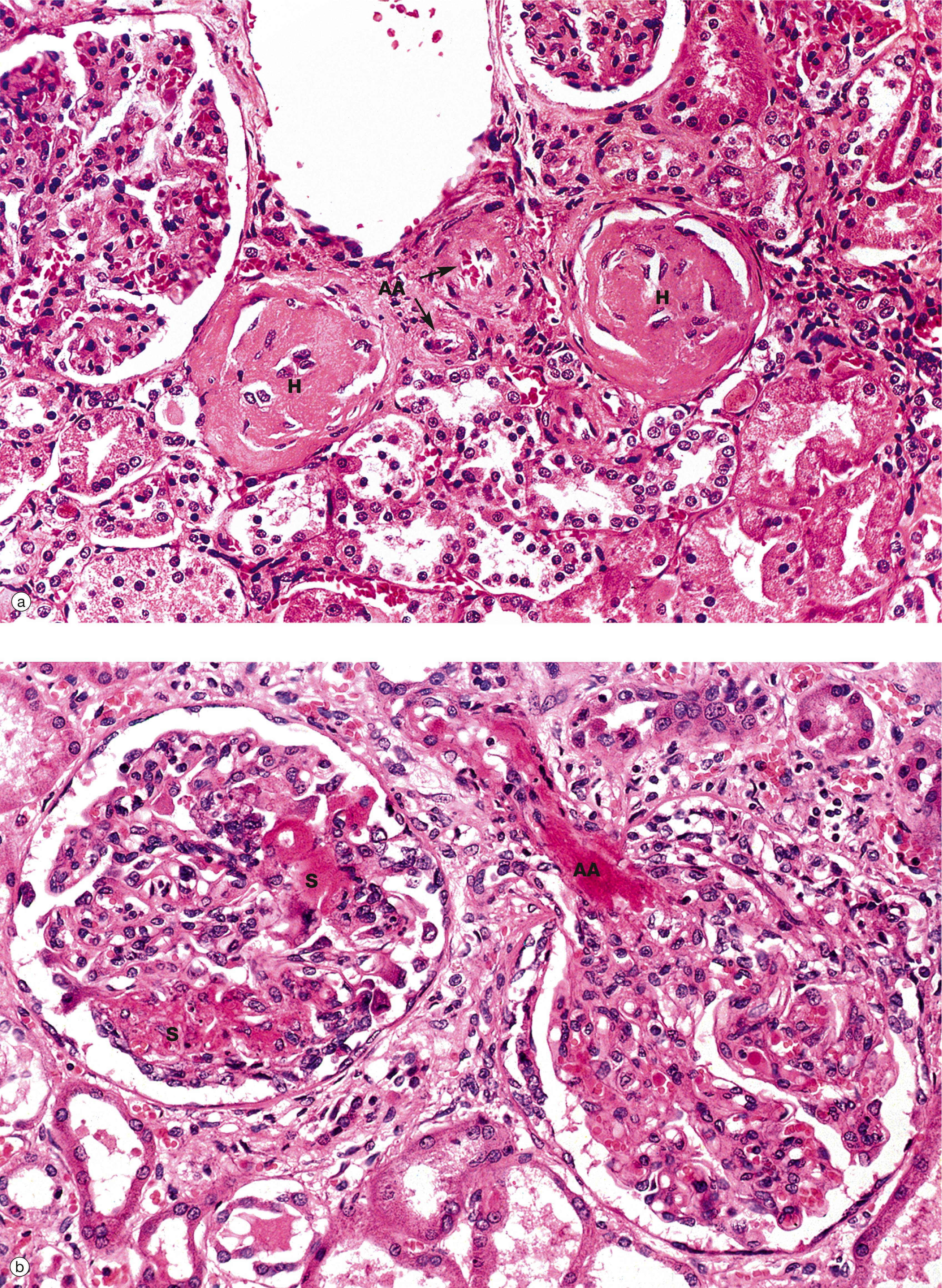 E-Fig. 16.5, Hypertensive nephrosclerosis