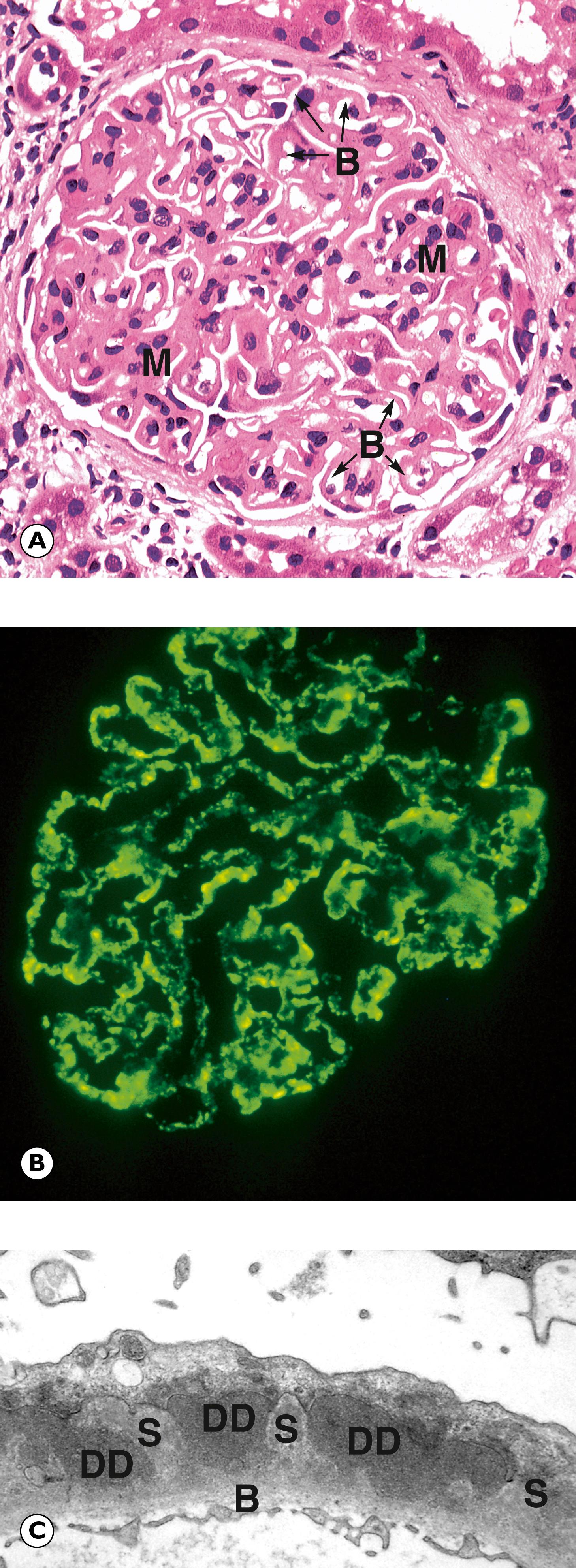 Fig. 15.6, Membranous nephropathy. (A) H&E (HP); (B) IgG immunofluorescence (HP); (C) EM.