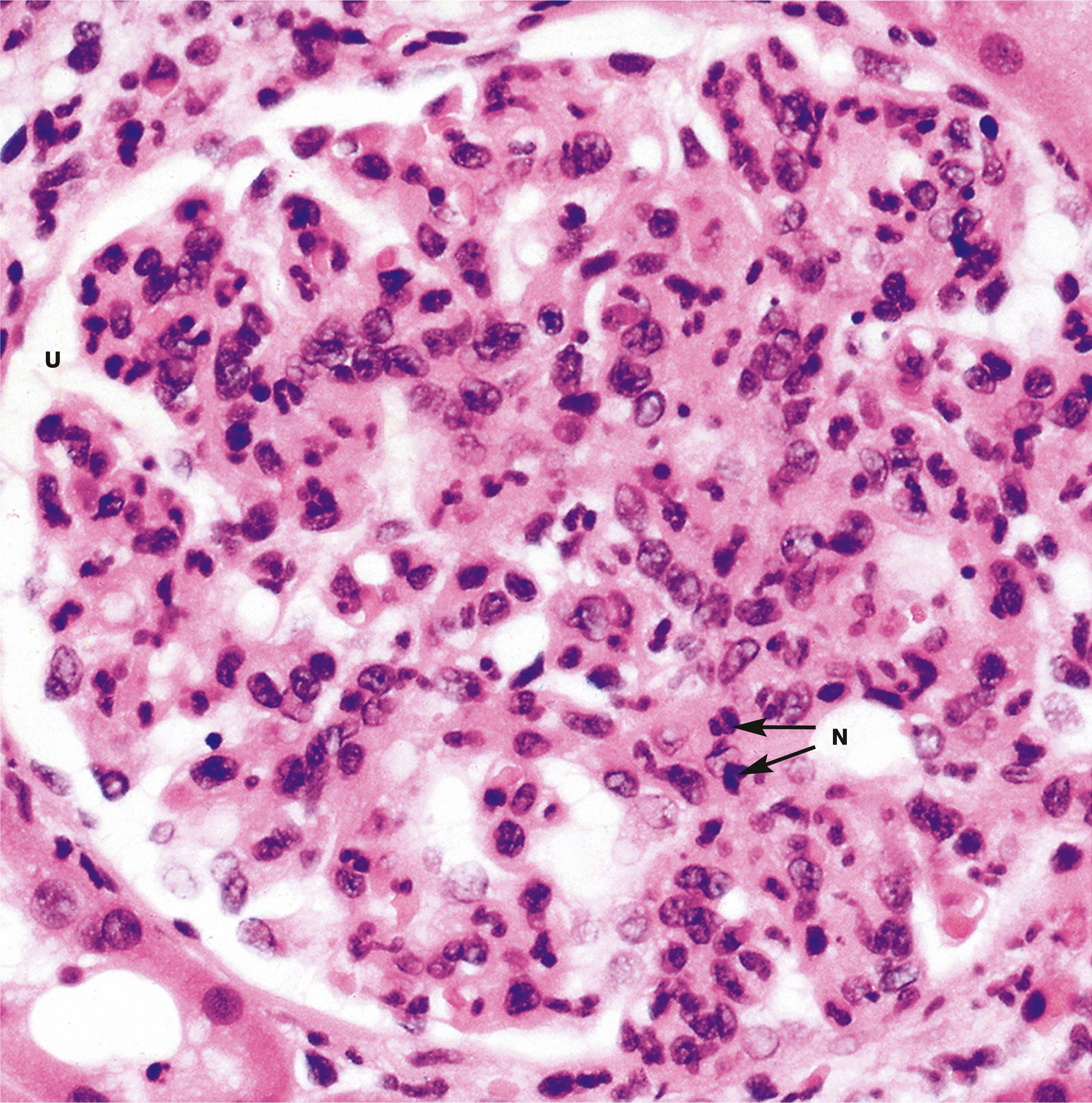 E-Fig. 16.1, Acute diffuse proliferative (‘endocapillary’) glomerulonephritis (HP)