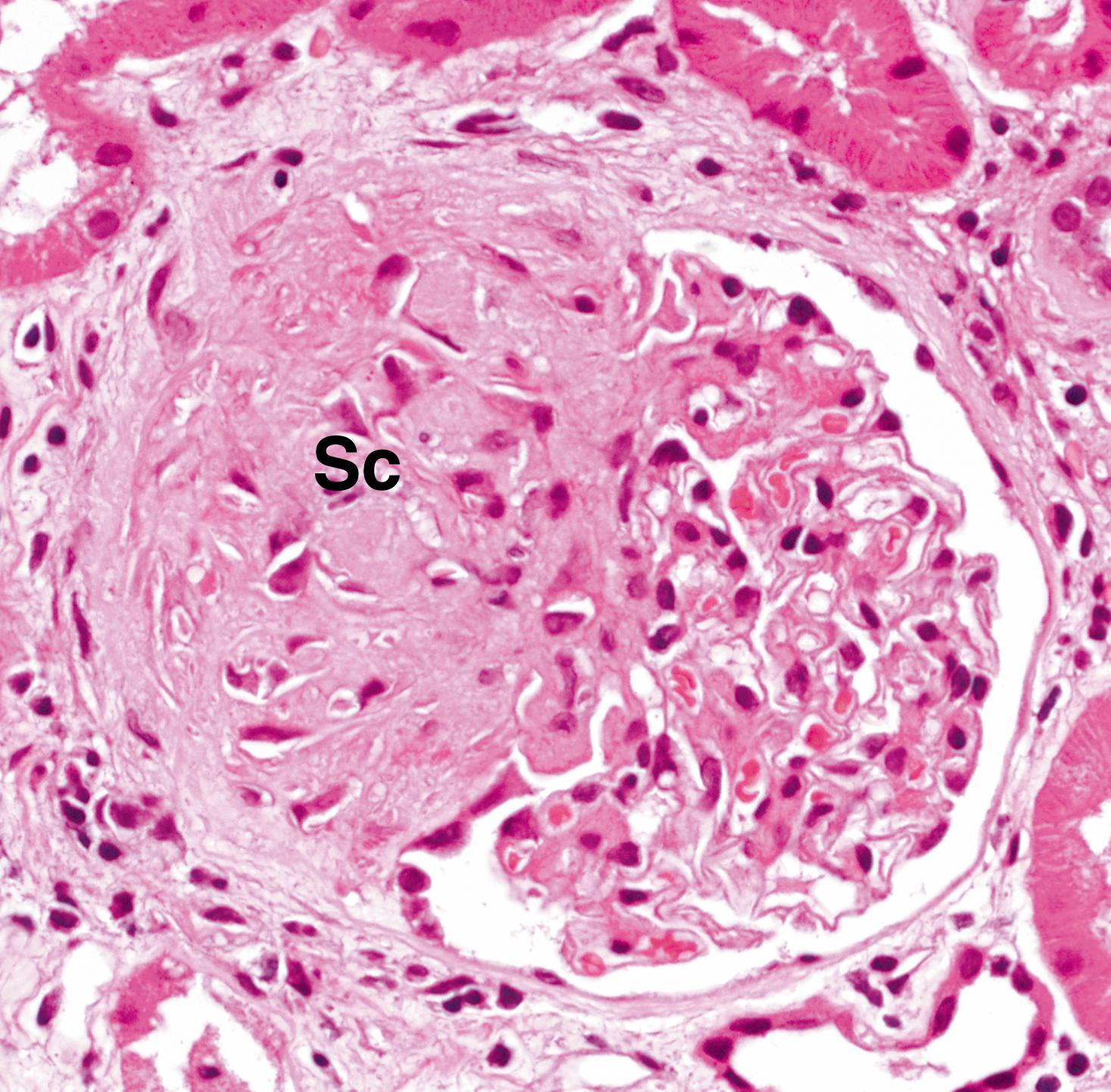 Fig. 15.7, Focal segmental glomerulosclerosis (HP).