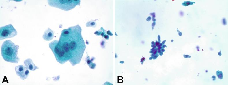 Fig. 7.1, Normal superficial (umbrella) cells.