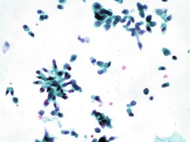 Fig. 7.2, Columnar cells in bladder wash.