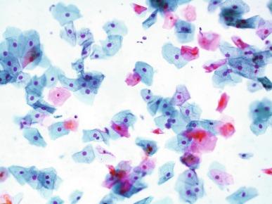 Fig. 7.3, Squamous cells in the urine.