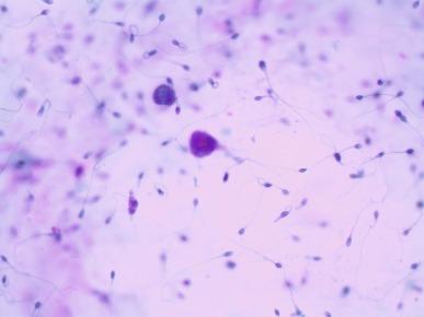 Fig. 7.5, Seminal vesicle cells and sperm in voided urine.