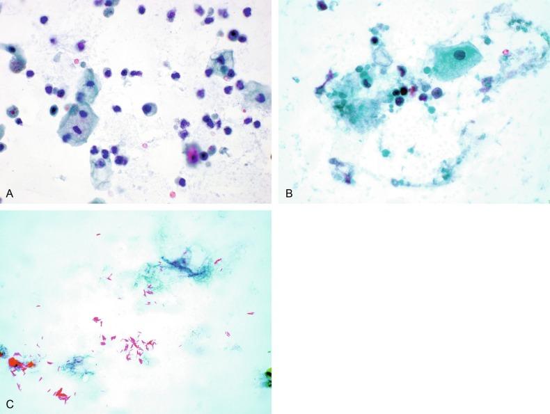 Fig. 7.6, (A) Acute cystitis, consisting of marked inflammation, degenerate urothelial cells, and scattered superficial cells. (B) Necrosis and macrophages in tuberculosis of bladder. (C) Acid-fast bacilli in urine (Ziehl-Neelsen stain).