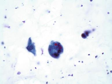 Fig. 7.7, Degenerate urothelial cells with cytoplasmic inclusions (Melamed-wolinska bodies).