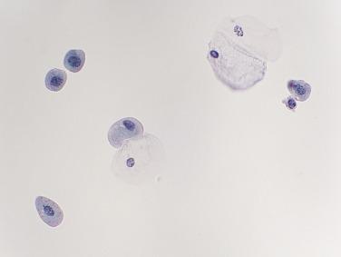 Fig. 3.1, Normal Voided Urine.