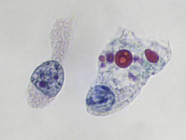 Fig. 3.2, Cytoplasmic Inclusions (Melamed-Wolinska Bodies).