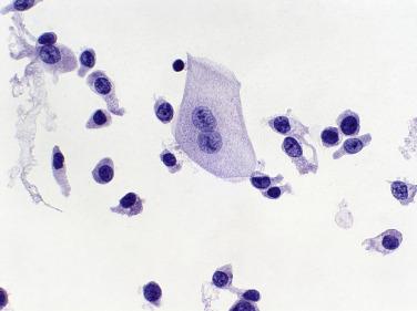 Fig. 3.3, Umbrella Cells (Ureteral Washing).