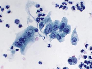 Fig. 3.4, Benign Urothelial Cells Can Have a Folded and Flattened Nucleus (Catheterized Specimen).