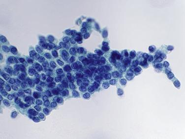 Fig. 3.5, Basal Urothelial Cells (Catheterized Specimen).