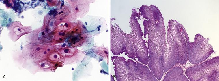 Fig. 3.9, Condyloma Acuminatum of Bladder (Catheterized Urine).