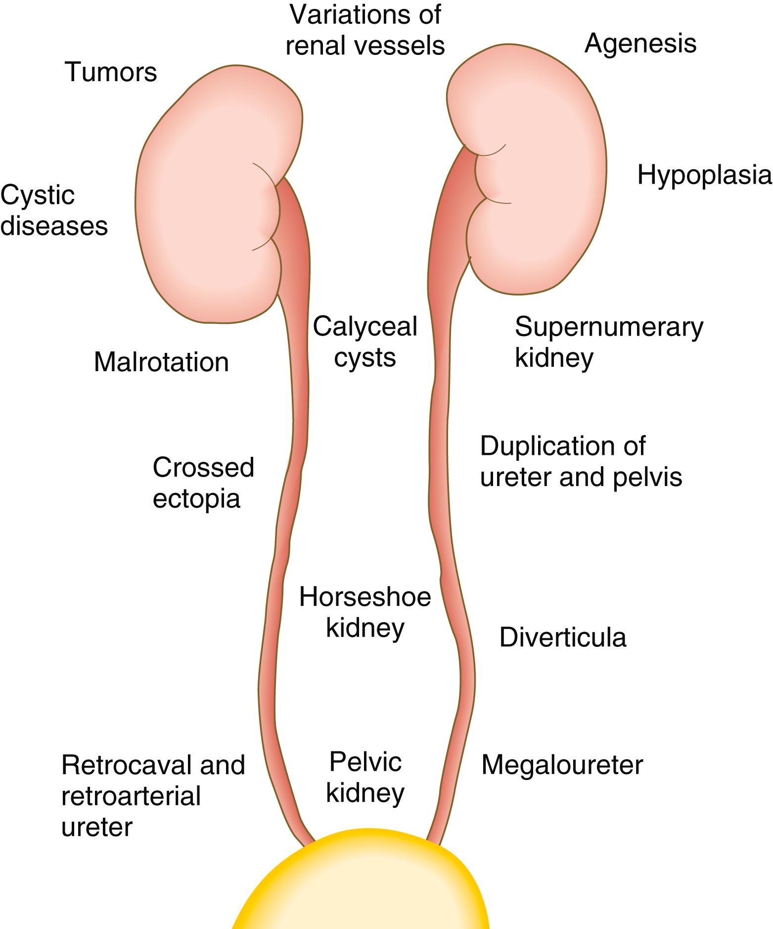 Fig. 16.13, Types and sites of anomalies of the kidneys and ureters.