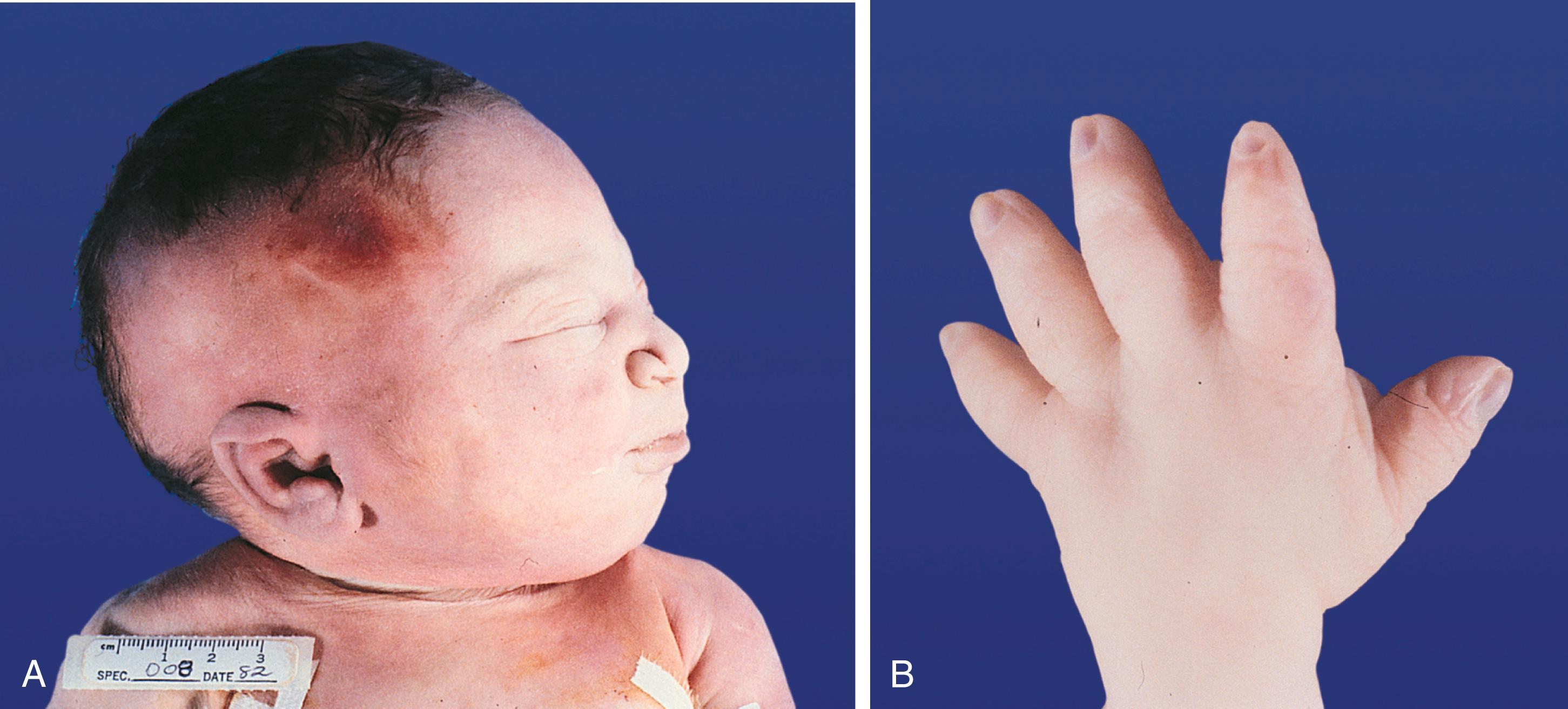 Fig. 16.15, (A) Potter’s facies, which is characteristic of a fetus exposed to oligohydramnios. Note the flattened nose and low-set ears. (B) Potter’s hand with thickened, tapering fingers.