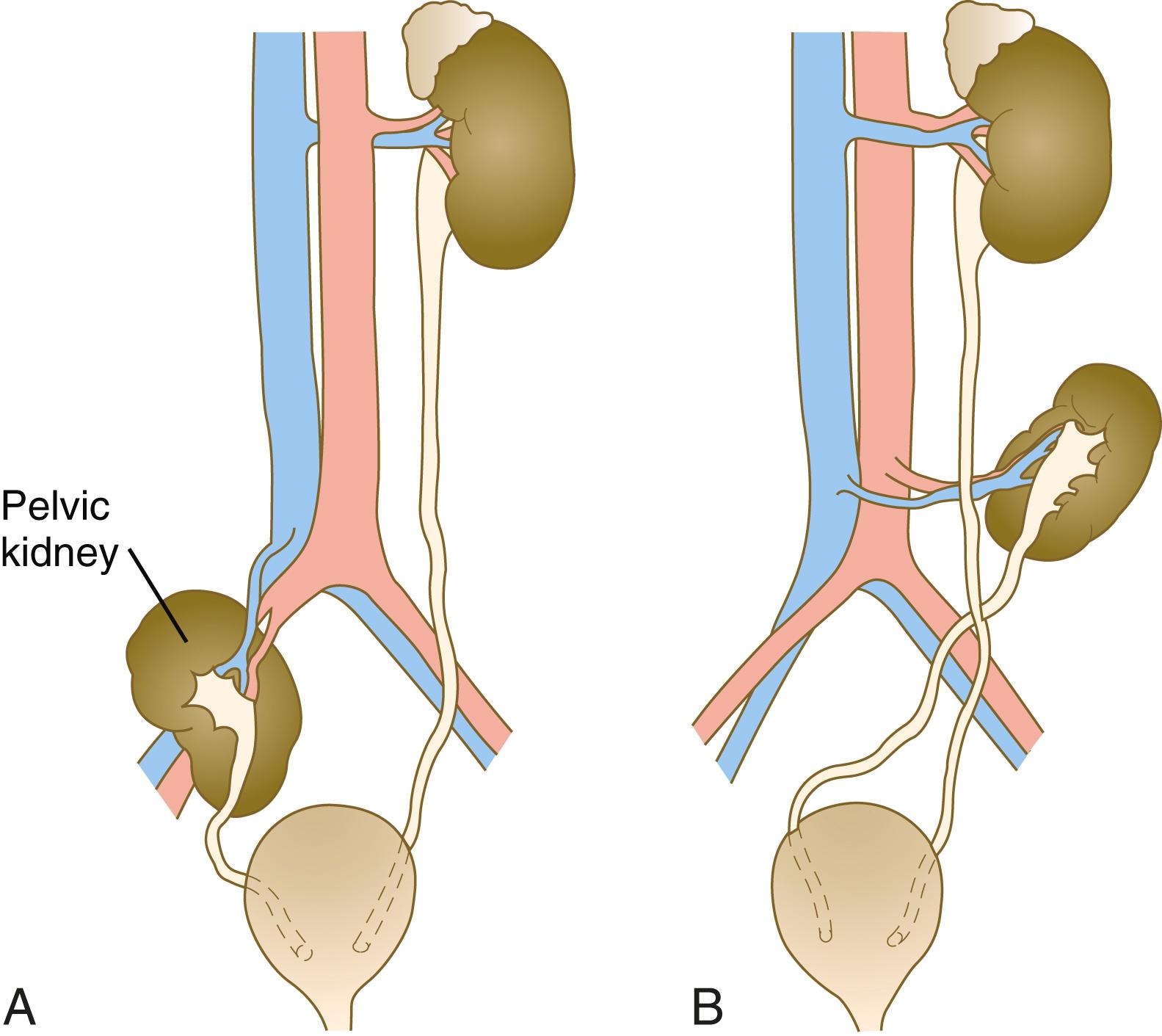 Fig. 16.17, Migration defects of the kidney.