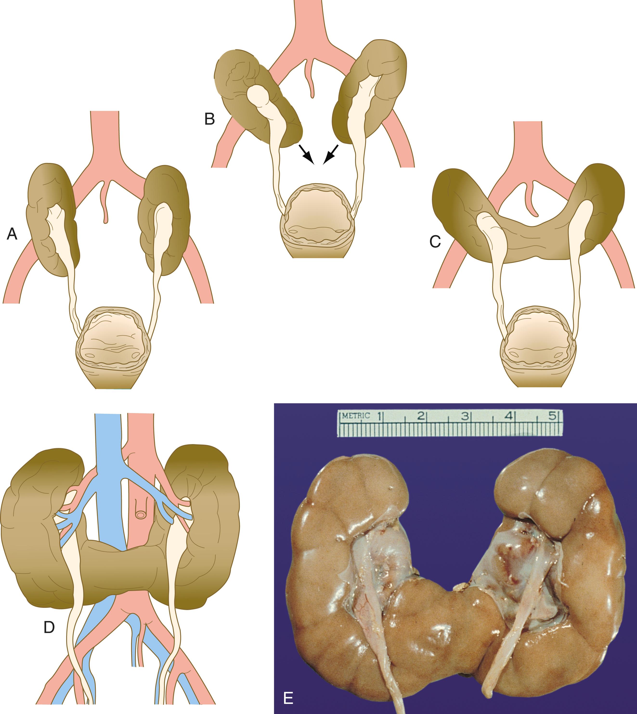 Fig. 16.18, Stages in the formation of a horseshoe kidney.