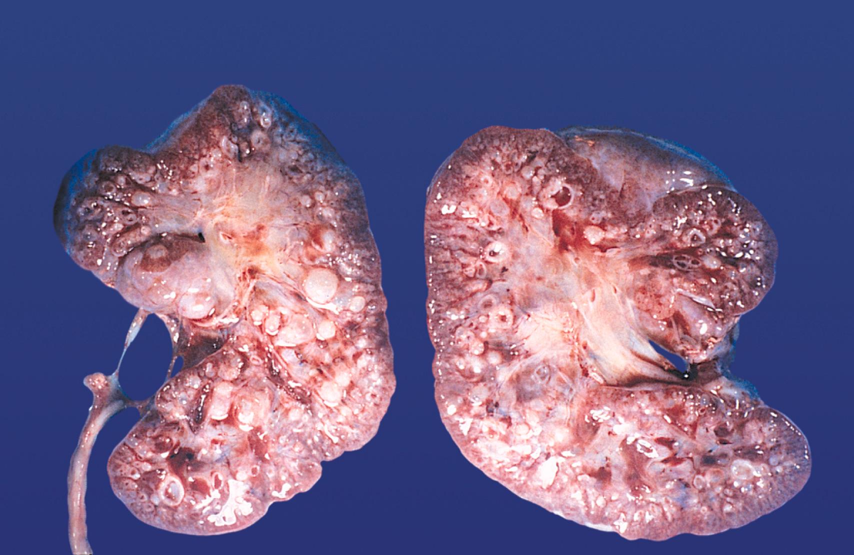 Fig. 16.19, Polycystic kidneys.