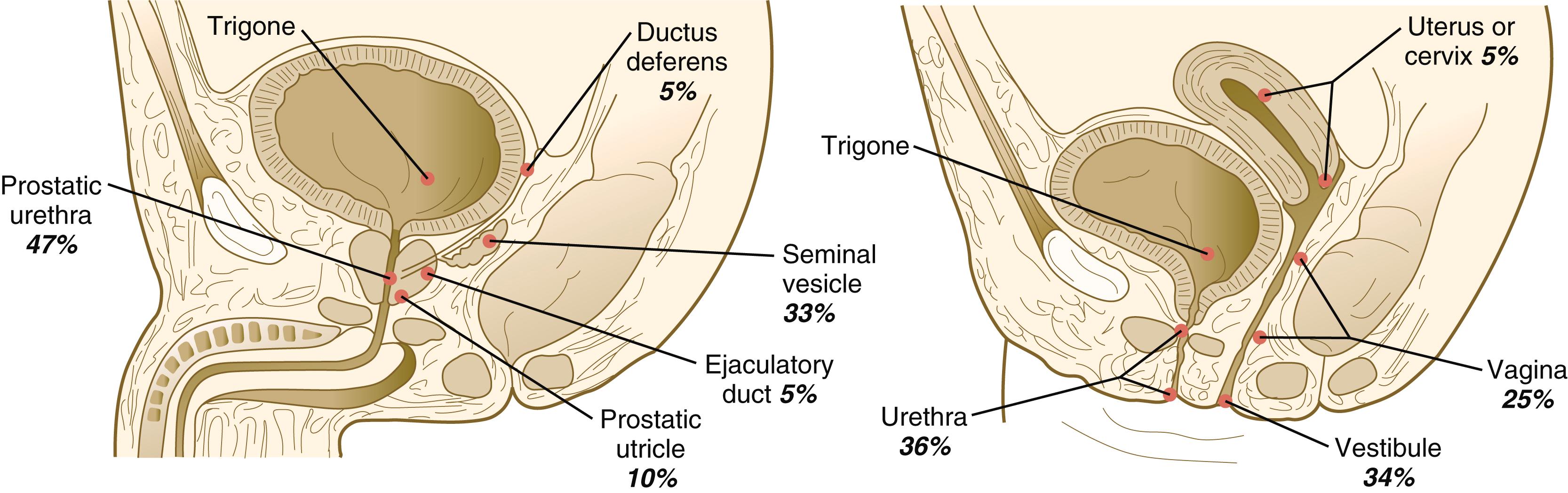 Fig. 16.20, Common sites of ectopic ureteral orifices.