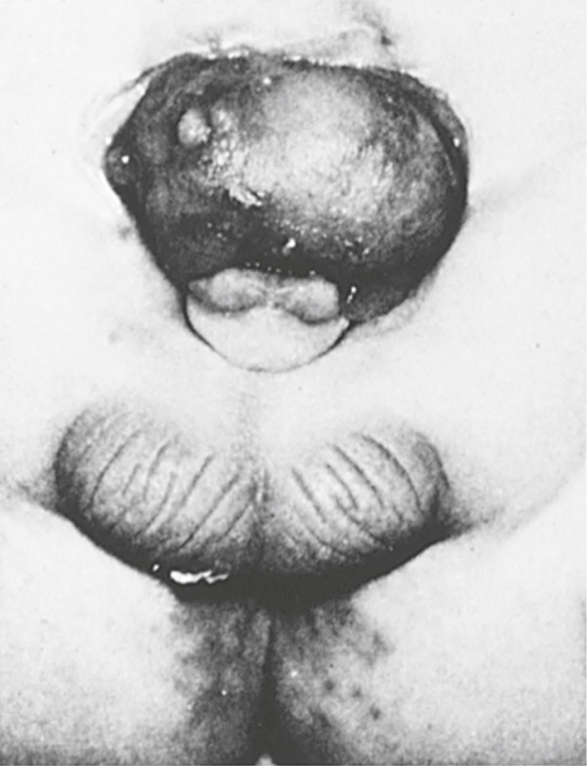 Fig. 16.22, Exstrophy of the bladder in a male infant, showing protrusion of the posterior wall of the bladder through a defect in the lower abdominal wall.