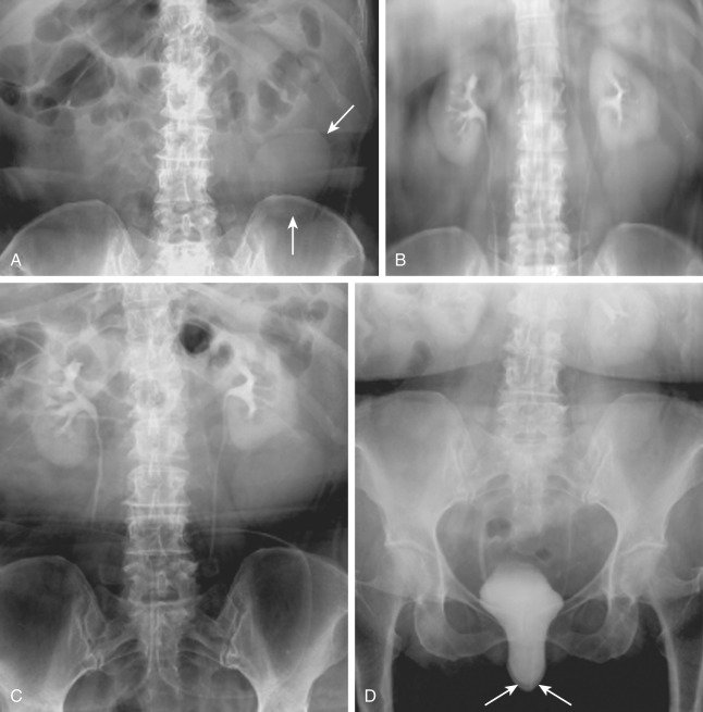 Figure 33-1, Renal cyst and cystocele on IVU. A, Preliminary image shows rounded density projecting from lower pole of left kidney ( arrows ), suggesting presence of left renal mass. B, Nephrotomogram demonstrates right kidney to be normal. Mass in left renal lower pole is seen well. US subsequently showed this to be due to simple renal cyst ( not shown ). C, Radiographic image at 12 minutes after intravenous contrast administration with abdominal compression reveals well-distended collecting systems and ureters, with ureteral contrast columns obstructed by compression balloons. Urothelial abnormalities are difficult to detect in underdistended collecting systems. D, Erect radiographic image shows near-complete drainage of contrast from collecting systems and ureters. Note abnormal descent of bladder below symphysis pubis ( arrows ) in this elderly woman representing cystocele caused by pelvic floor laxity (see Chapter 34 for more details regarding cystocele).