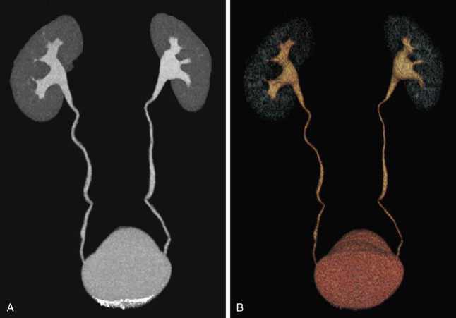 Figure 33-2, Normal CTU. A, Coronal maximum intensity projection (MIP) and B, Volume-rendered (VR) CT images through abdomen and pelvis acquired during excretory phase of enhancement demonstrate normal-appearing collecting systems, ureters, and urinary bladder. Thin-section CT images are also available for detailed evaluation of renal parenchyma and urothelium ( not shown ).