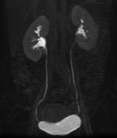 Figure 33-3, Normal MRU. Coronal maximum intensity projection (MIP) MR image through abdomen and pelvis acquired during excretory phase of enhancement reveals grossly normal-appearing collecting systems, ureters, and urinary bladder. Multiplanar T1-weighted and T2-weighted images are also available for detailed evaluation of the renal parenchyma and urothelium ( not shown ).