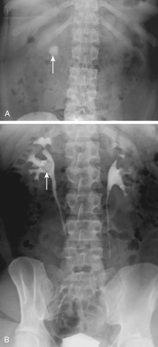 Figure 33-4, Renal calculus on IVU. A, Preliminary abdominal radiograph centered over kidneys shows radiopaque calculus in right kidney ( arrow ). B, Radiographic image acquired during excretory phase following intravenous contrast administration demonstrates filling defect due to calculus ( arrow ) in right renal pelvis partially obscured by high-density excreted contrast material.