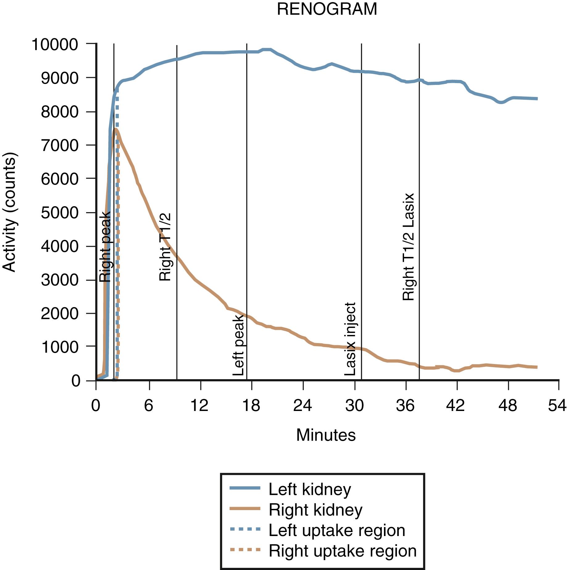 Fig. 15.11, Diuresis renogram. The radionuclide is administered, followed by a diuretic. The curves show a normal right kidney (prompt decrease in counts as the radionuclide is washed out of the collecting system) and an obstructed left kidney (only a small fraction of the radionuclide is slowly drained out of the collecting system).