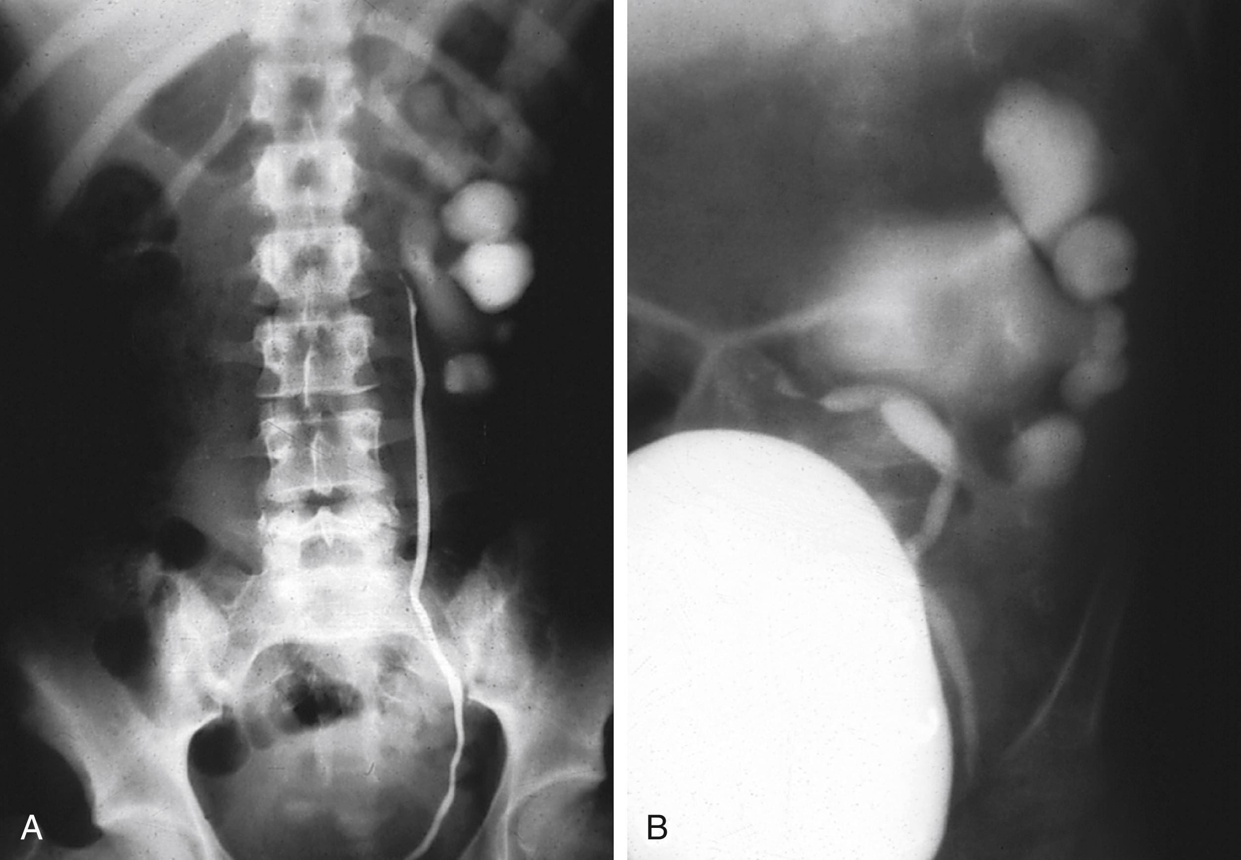 Fig. 15.12, Ureteropelvic junction (UPJ) obstruction. (A) Retrograde ureterogram defines obstruction at the UPJ. (B) The coexistence of vesicoureteric reflux and UPJ obstruction is seen in this voiding cystourethrogram. The diluted contrast noted in the renal pelvis compared to the bladder and ureter is indicative of a UPJ obstruction.