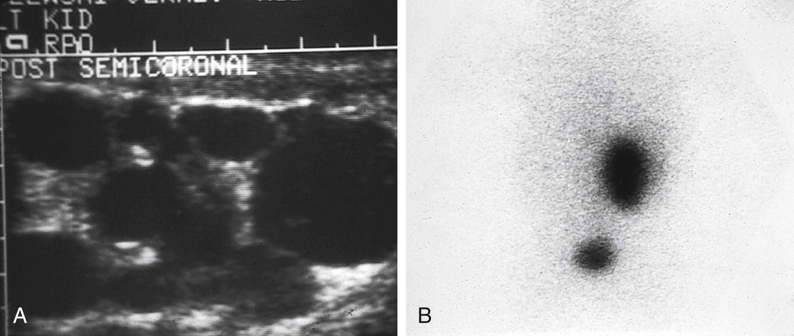 Fig. 15.13, Multicystic dysplasia. (A) Ultrasound examination of a multicystic kidney. (B) Nuclear medicine scan of a nonfunctional left multicystic dysplastic kidney (posterior view). The top area of contrast represents the right kidney, and the lower one is the bladder.