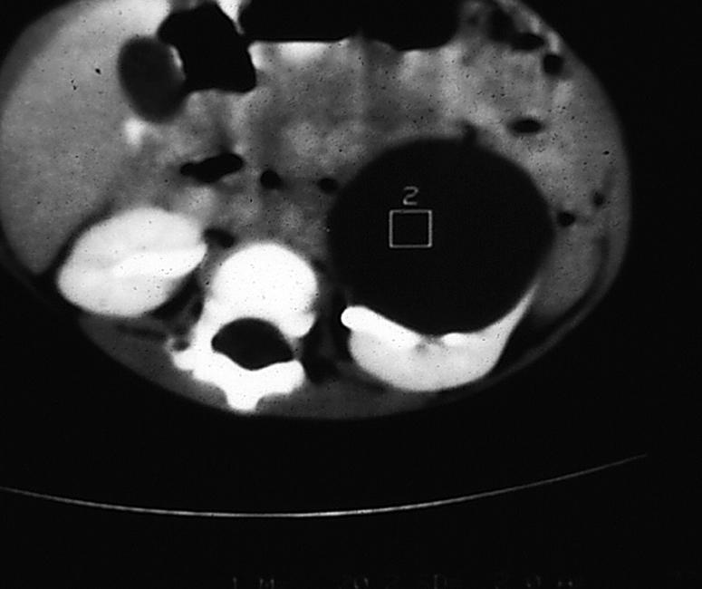 Fig. 15.14, Simple renal cyst. Computed tomography (CT) scan of a huge left renal cyst, which presented as a left upper quadrant abdominal mass.