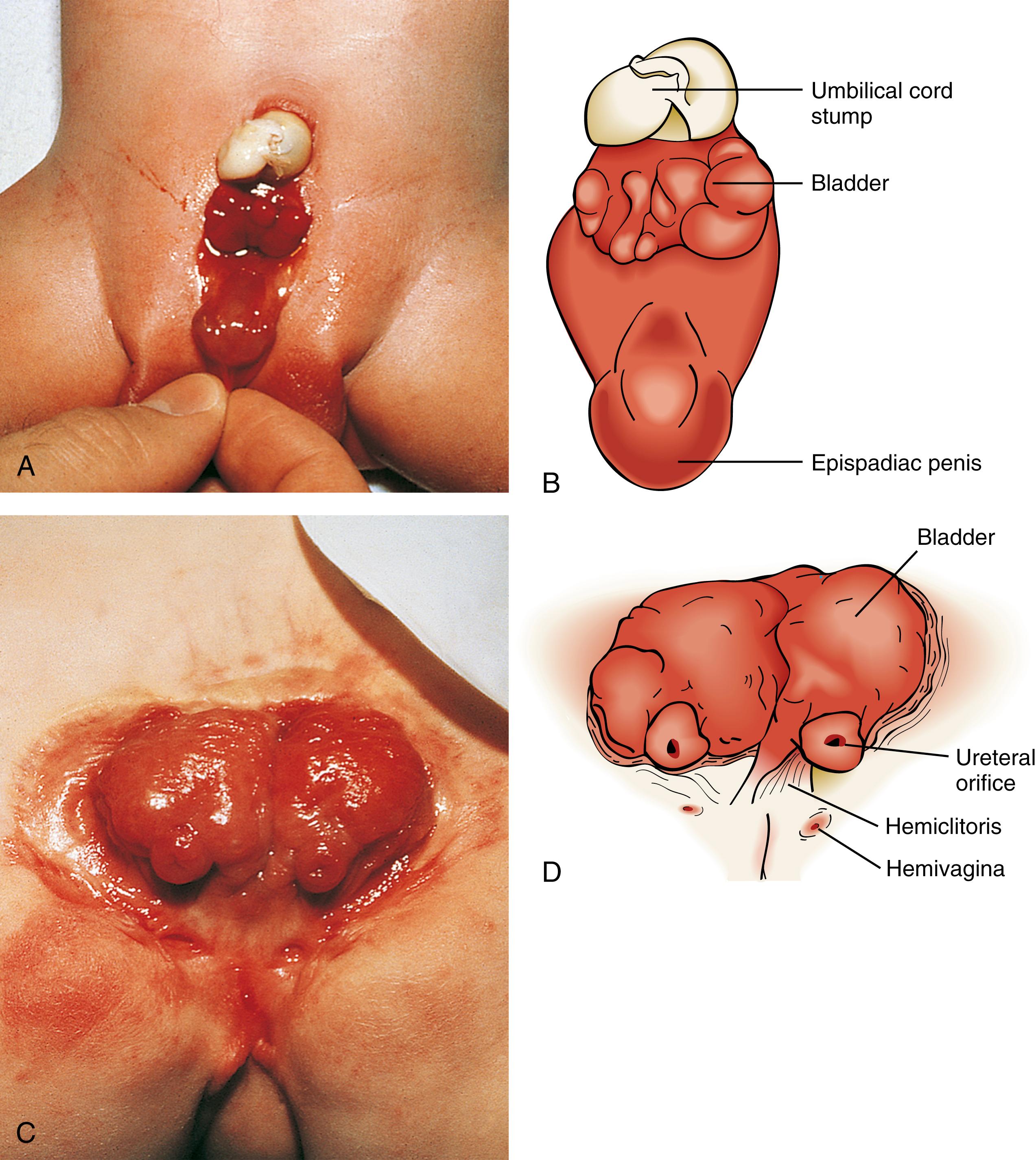 Fig. 15.15, Exstrophy. (A and B) Classic bladder exstrophy in a boy infant with a small bladder. (C and D) Bladder exstrophy in a girl. Note the separate openings to each hemivagina.