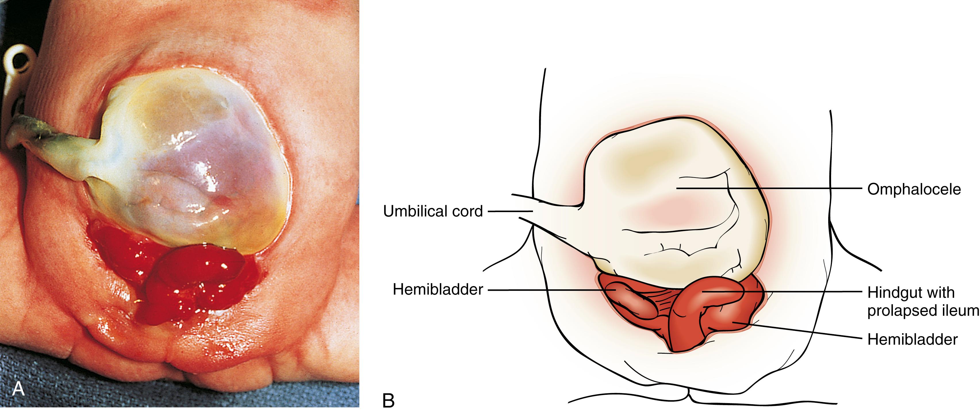 Fig. 15.16, (A and B) Cloacal exstrophy.