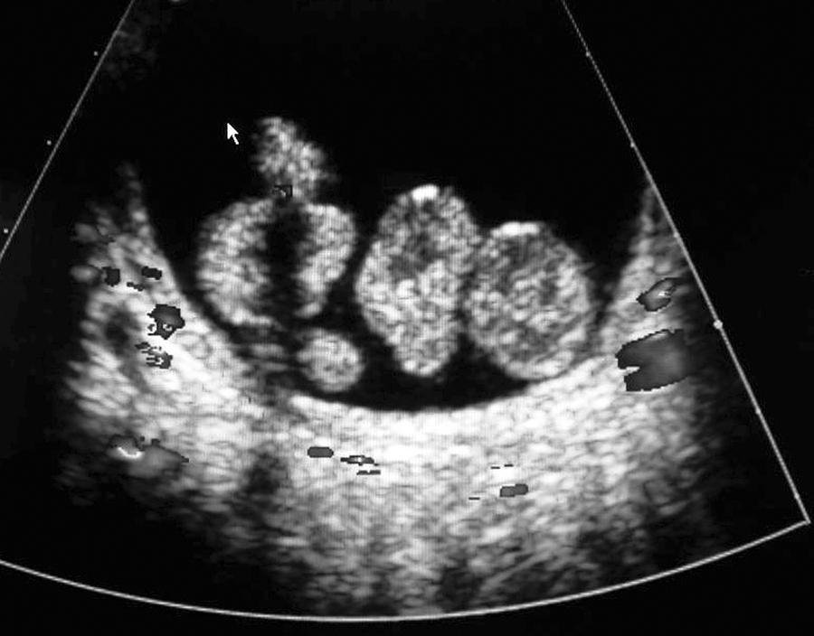 Fig. 15.19, Bladder rhabdomyosarcoma. Shown is an ultrasound examination of the bladder in a boy who presented with urinary retention. The study reveals polypoid lesions of a botryoid rhabdomyosarcoma, which obstructed the bladder outlet, causing urinary retention.