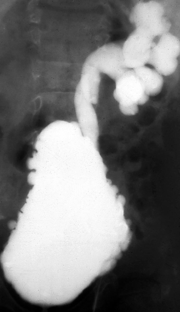 Fig. 15.20, Neurovesical dysfunction. Severe bladder trabeculation and vesicoureteric reflux in a child with myelomeningocele.