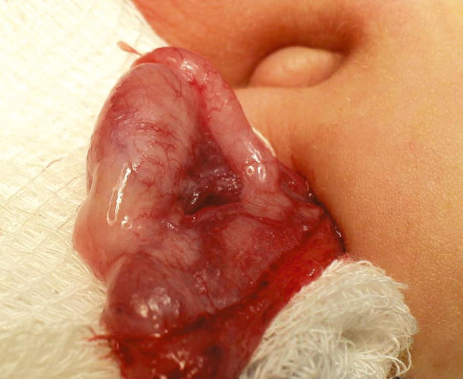 Fig. 15.2, Androgen insensitivity. Left inguinal testis in an XY phenotypic female with androgen insensitivity.